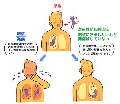 潜在性結核感染症