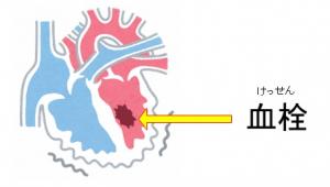 不整脈　血栓　イラスト　01